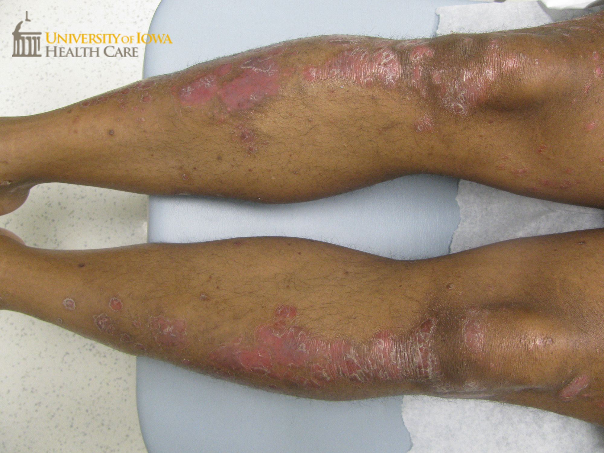 Salmon-colored papules and plaques with collarette of scale on the lower legs. (click images for higher resolution).